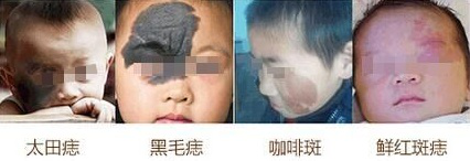 胎记种类.png