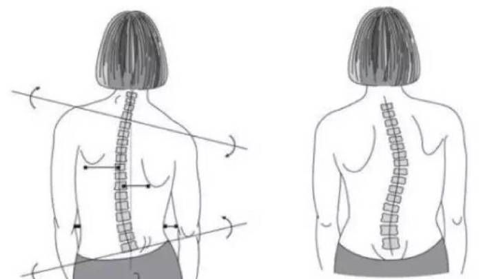含胸駝背沒氣質運動幾下還帶喘或許你該看看是不是脊柱側彎了