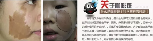 咖啡斑.png