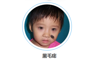 黑毛痣 (3).png