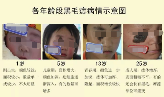 黑毛痣.png
