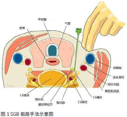 传统SGB.jpg