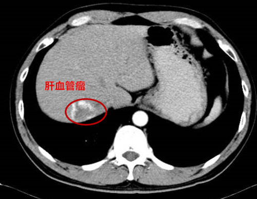 肝血管瘤直径图片