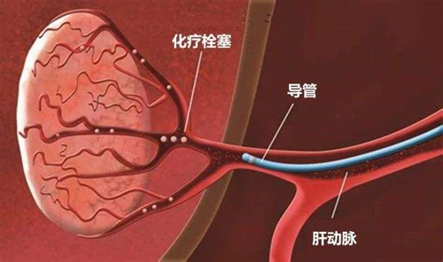 即是通過阻塞滋養肝癌腫瘤動脈血管,並釋放化療藥物的介入方式)3