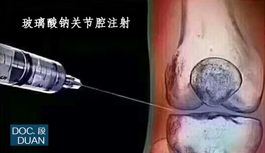 HA玻璃酸钠关节腔注射.png