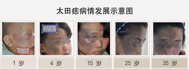 太田痣发展示意图.png
