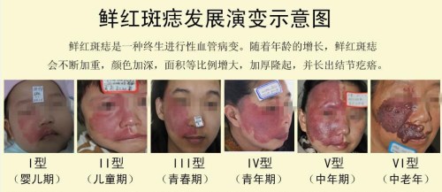鲜红斑痣发展意图.jpg