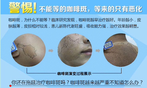 咖啡斑早治疗.png