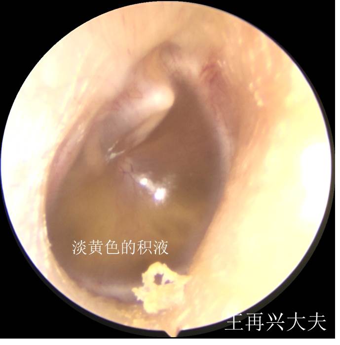 分泌性中耳炎.jpg