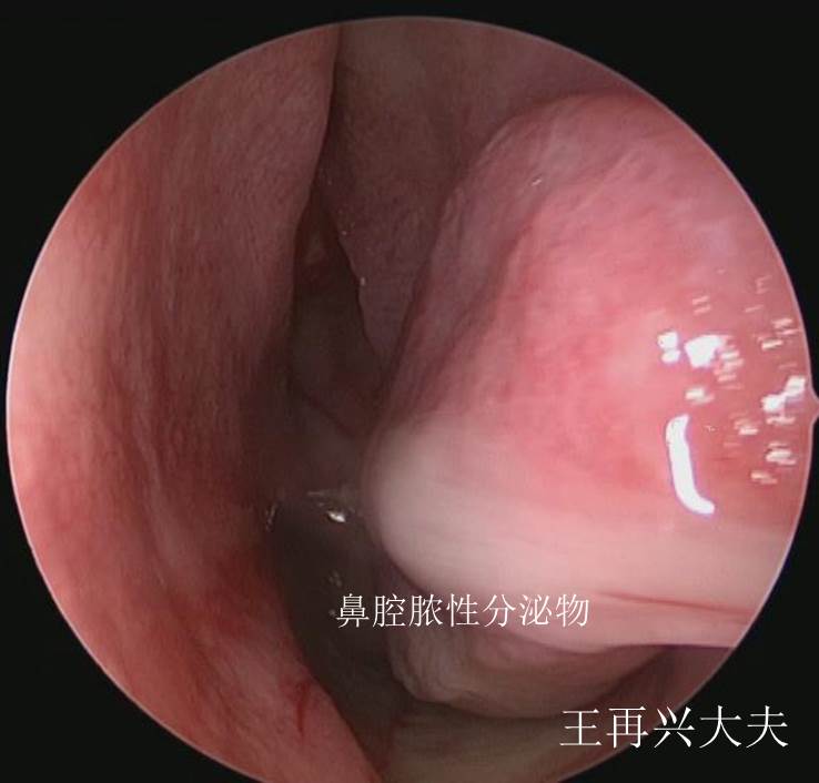 鼻腔分泌物.jpg