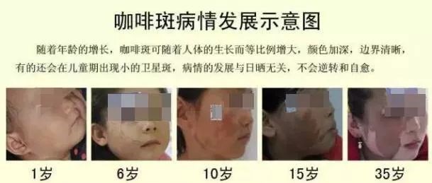 咖啡斑发展意图.jpg