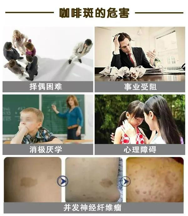 咖啡斑的危害.jpg