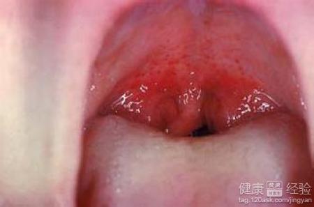 急性咽炎.jpg