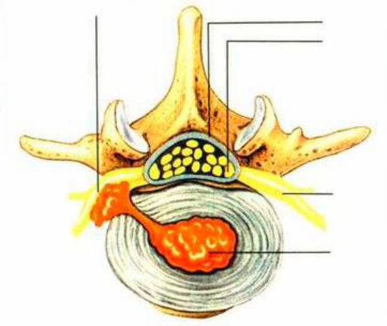椎間盤突出症是指因椎間盤變性,纖維環破裂,髓核突出刺激或壓迫神經根