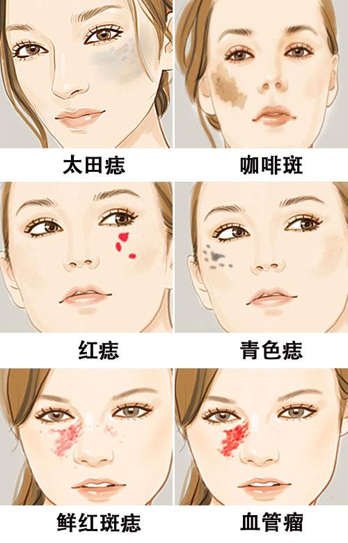 胎记的类型.jpg