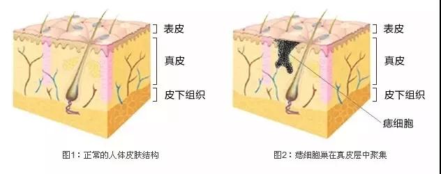 黑胎记的原因1.jpg