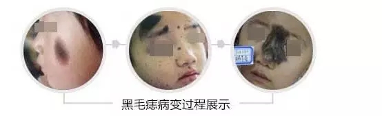 黑毛痣演变过程.jpg