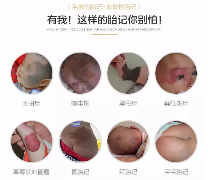 胎记总.png