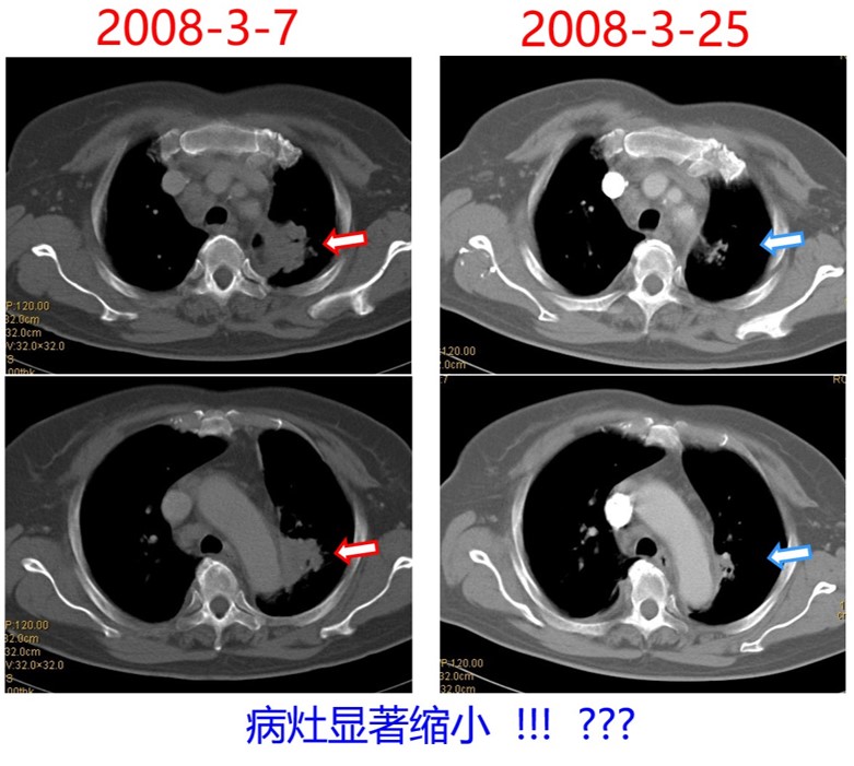 病灶缩小.jpg