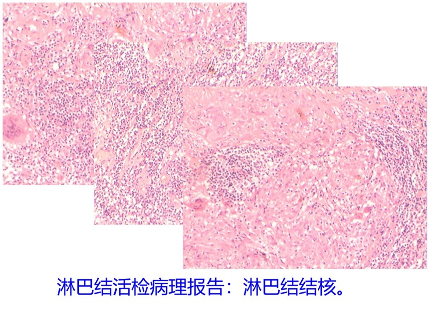 淋巴结活检病理.jpg