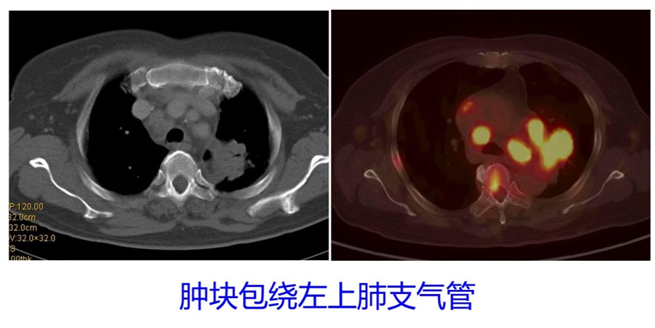 肿块包绕左上肺支气管.jpg