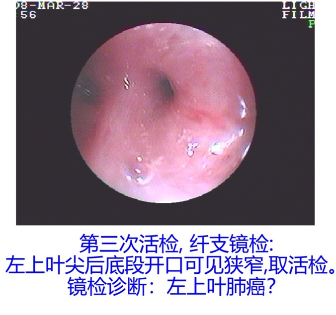 纤支镜诊断.jpg