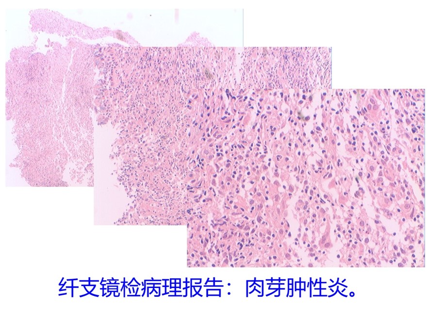 纤支镜病理.jpg