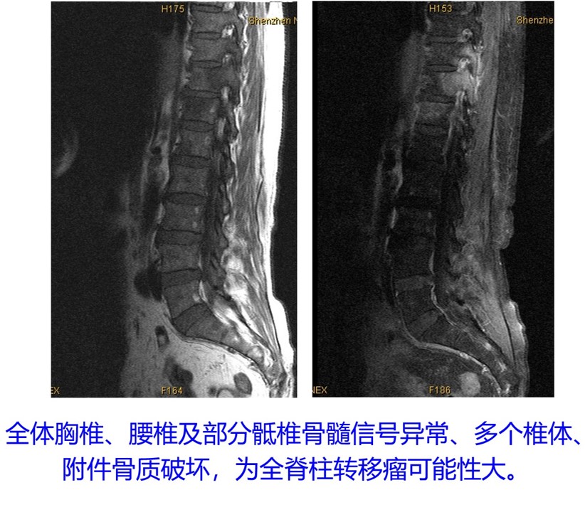 脊柱MRI.jpg