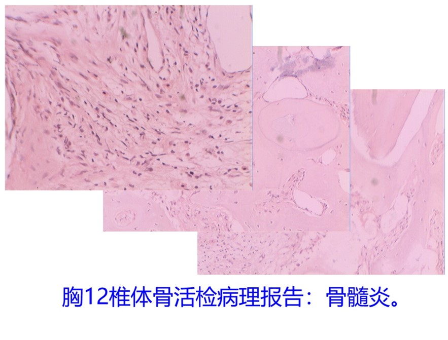 胸12活检病理.jpg