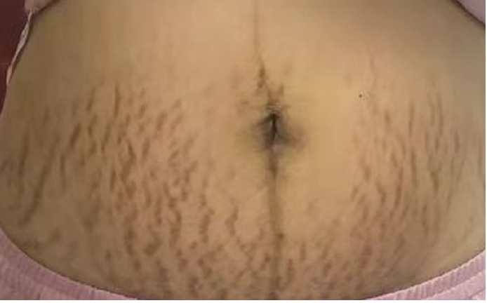 妊娠纹（约私150的图片）.jpg