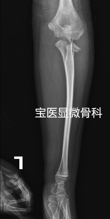 桡骨颈骨折-谢锦桦术前2_副本.jpg