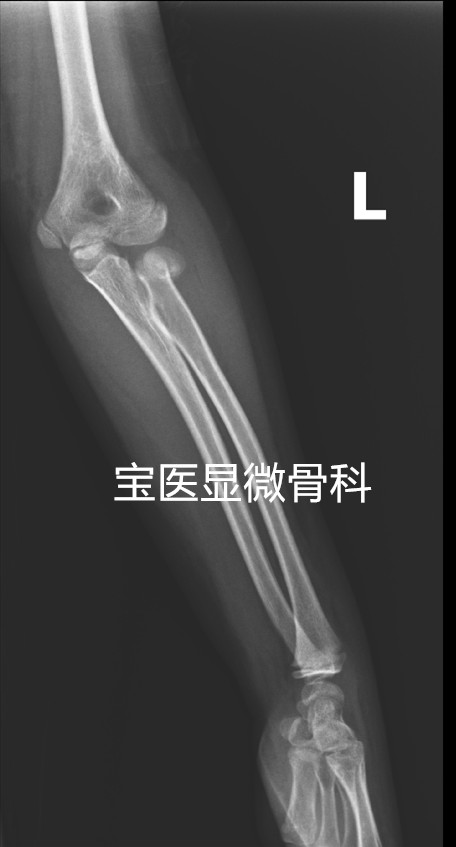 桡骨颈骨折-谢锦桦术前1_副本.jpg