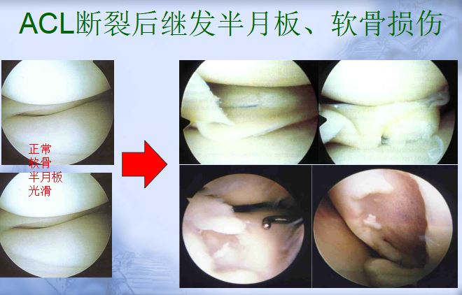 继发关节软骨损伤.JPG