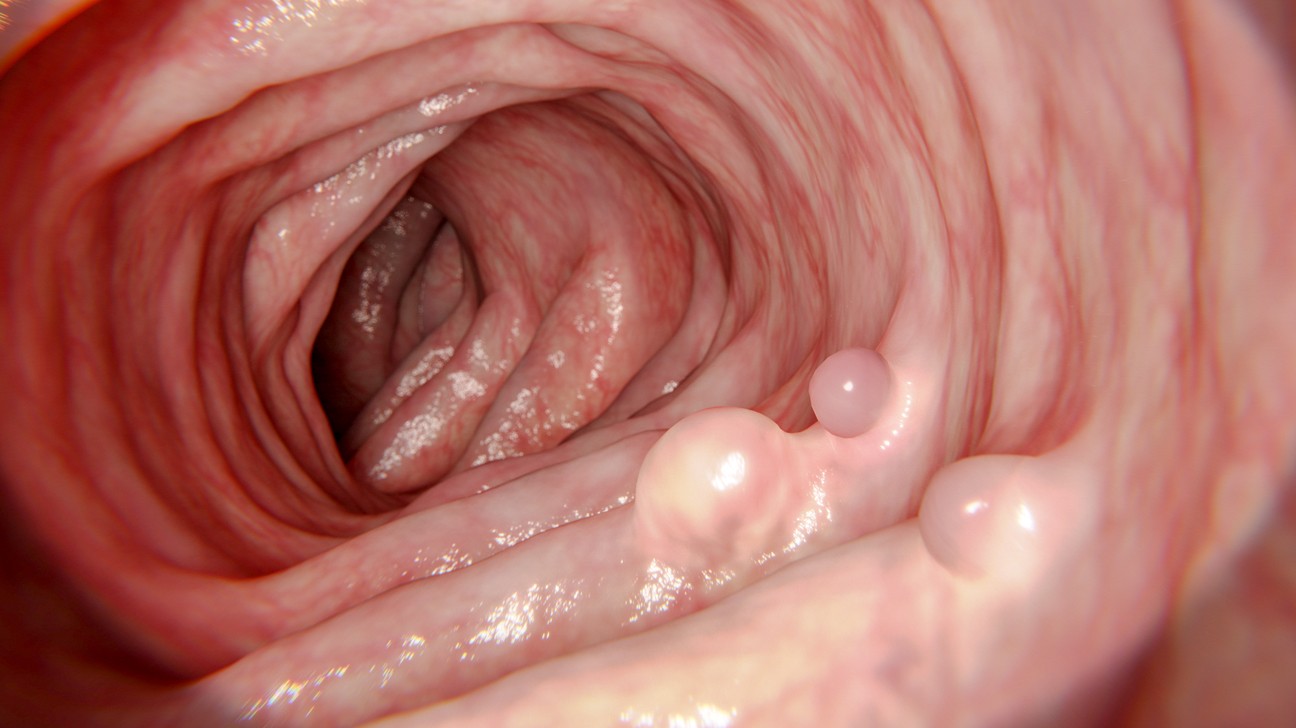 1571919319382511.jpg Colonic_polyps-1296x728-gallery_slide1.jpg