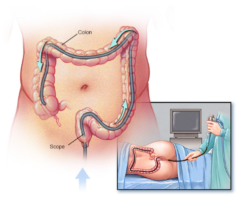 1571919432516589.png colonoscopy-1.png