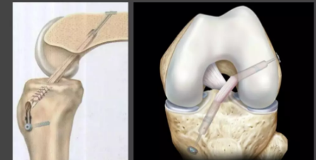 膝knee Acl 前交叉韧带 Acl 重建术后康复指南 我的方法 理论版 健康160