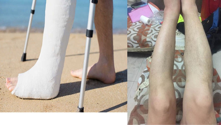 骨折腿细.jpg
