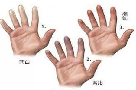 雷诺现象.jpg