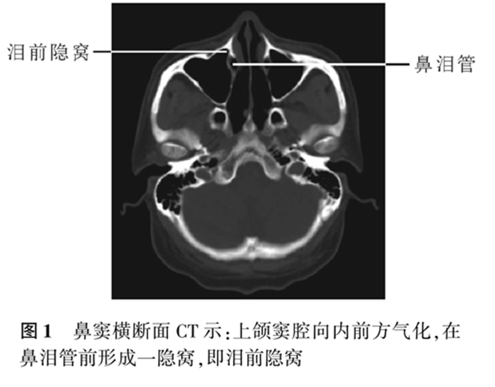 泪前隐窝位置.jpg