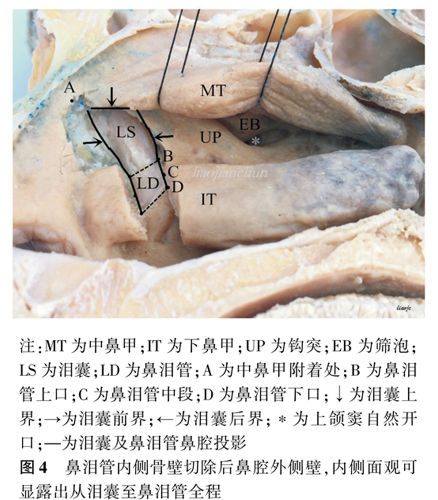 鼻泪管.jpg
