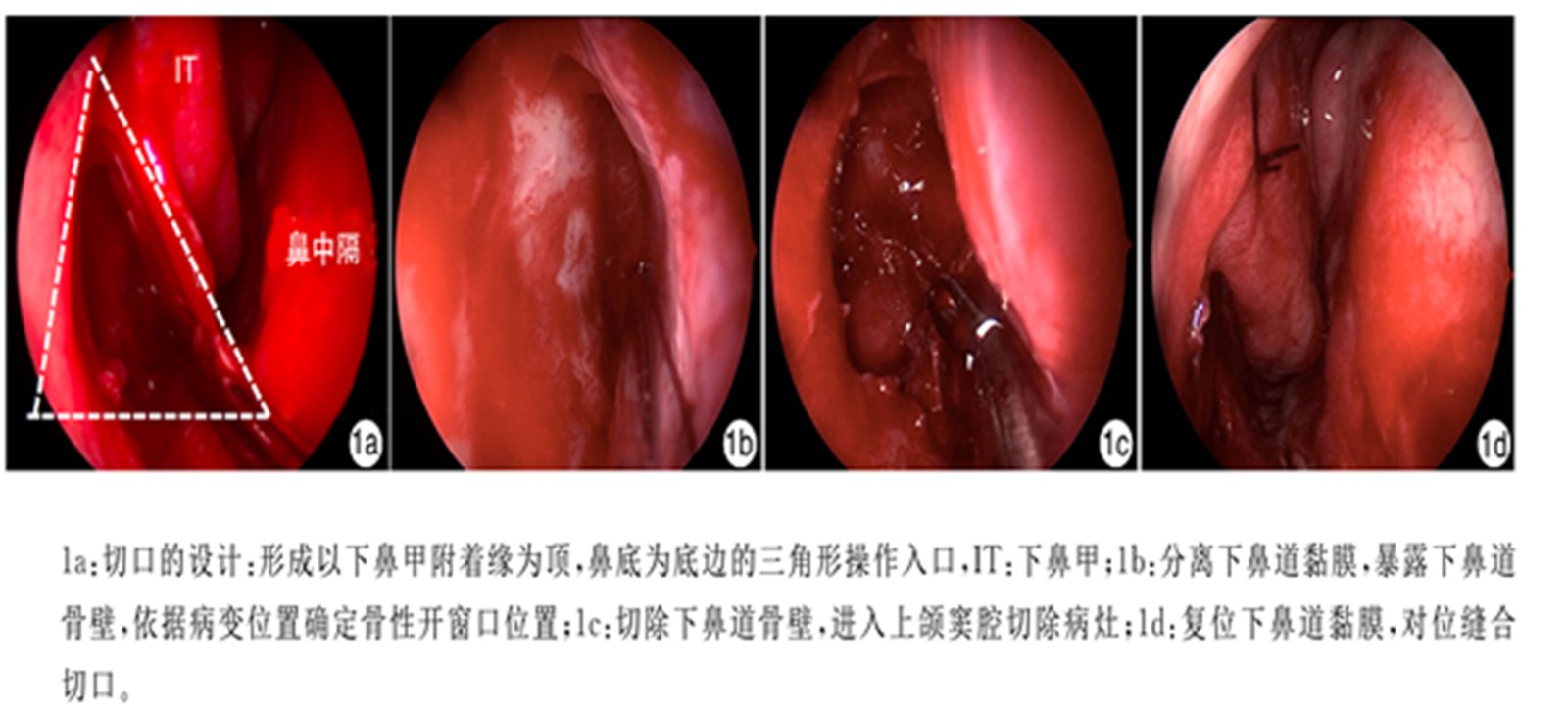 泪前手术.jpg