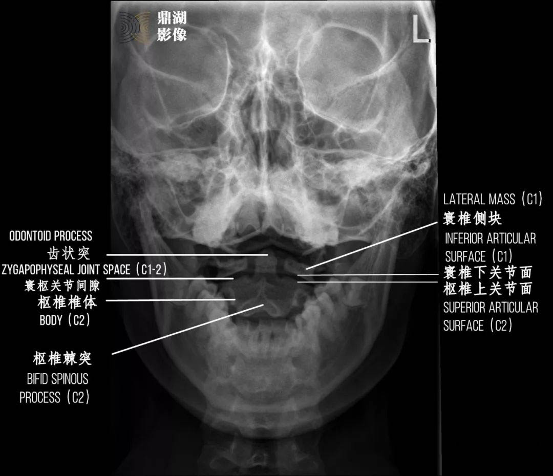 小明妈妈就带着拍片结果回来说:x片报告说我们孩子有寰枢关节紊乱,也