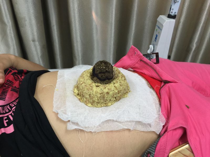 脐灸.jpg