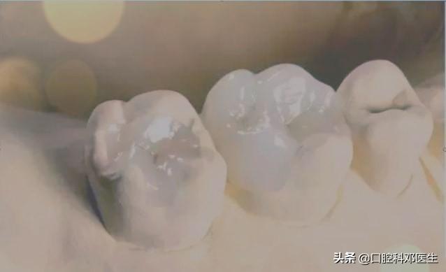 同样是补牙,嵌体却要贵上10倍!揭开“暴利”背后的面纱!