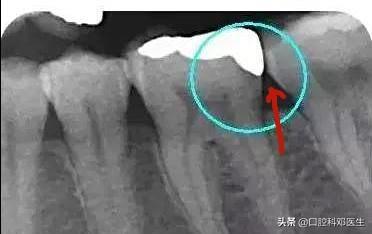 同样是补牙,嵌体却要贵上10倍!揭开“暴利”背后的面纱!
