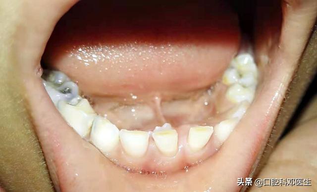 孩子换牙换得好不好，父母有不可推卸的责任！不要留下遗憾！