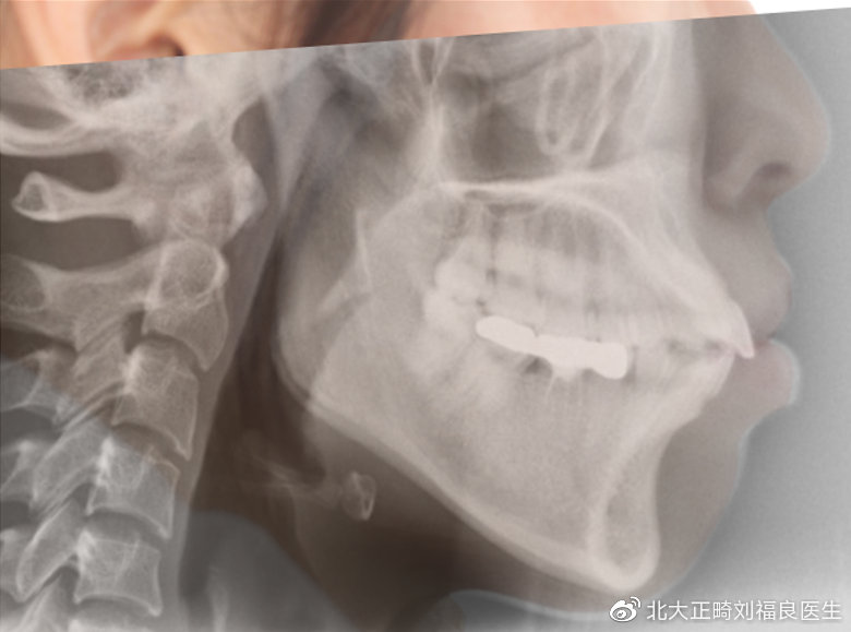 治疗前-X线与面像重叠