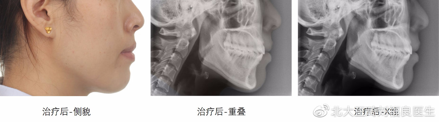 治疗后-X线片与面像重叠图