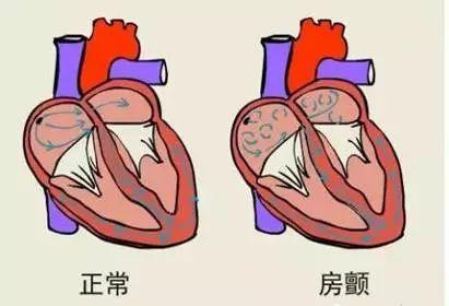 一文读懂：患上房颤究竟是选择手术治疗还是药物治疗？