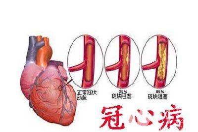 用药全解读：患上冠心病，哪些药其实不用吃？